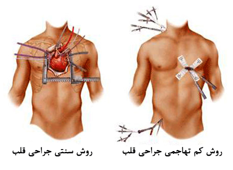 مقایسه روش جراحی قلب معمول با روش کم تهاجمی